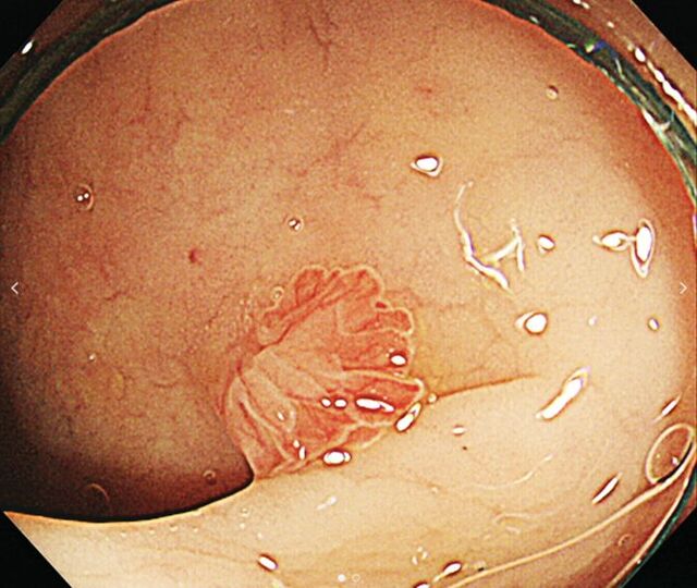 소수 유형의 대장 용종에 해당하는 전통적 톱니형 선종. 사진=대한위대장내시경학회 
