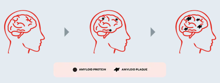 기억력 및 사고려 저하와 관련 있는 아밀라이드 플라크는 증상 발현 20년 전부터 축적되기 시작할 수 있다. (사진 = brainhealthmatters.lilly.com)